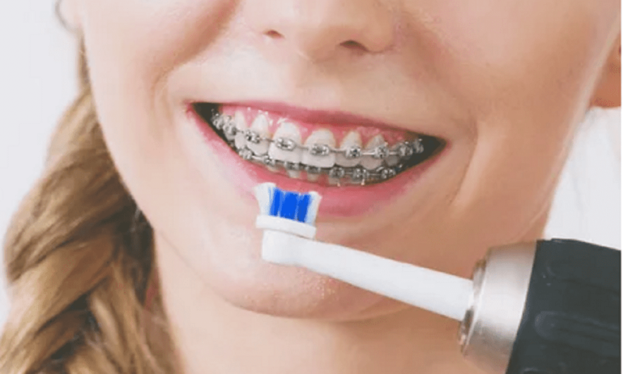 Peut-on utiliser une brosse à dents électrique avec un appareil dentaire ?